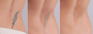 Eliminar Tatuajes Barcelona